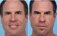 Dr. Balikian's Rhinoplasty Before & After Gallery - Patient 2167693 - Image 1