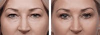 Dr. Balikian's Blepharoplasty Before & After Gallery - Patient 2167698 - Image 1