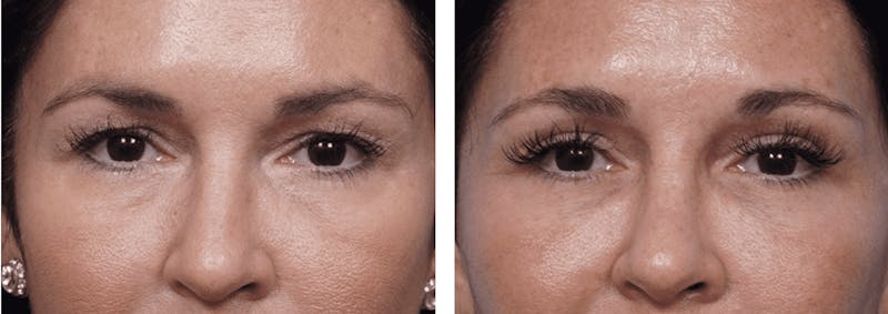 Dr. Balikian's Blepharoplasty Before & After Gallery - Patient 2167700 - Image 1