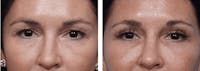 Dr. Balikian's Blepharoplasty Before & After Gallery - Patient 2167700 - Image 1