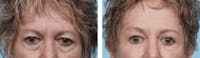 Dr. Balikian's Blepharoplasty Before & After Gallery - Patient 2167703 - Image 1