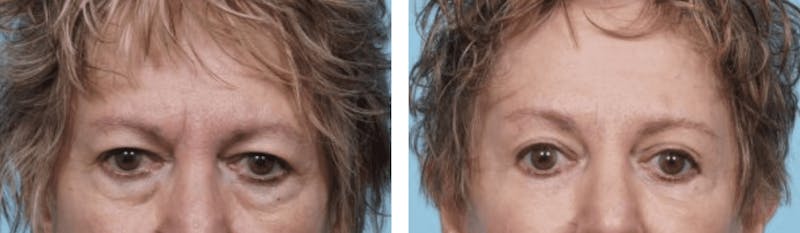 Dr. Balikian's Blepharoplasty Before & After Gallery - Patient 2167703 - Image 1
