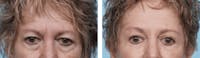 Dr. Balikian's Blepharoplasty Gallery - Patient 2167703 - Image 1