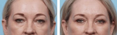 Dr. Balikian's Blepharoplasty Before & After Gallery - Patient 2167705 - Image 1