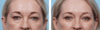 Dr. Balikian's Blepharoplasty Before & After Gallery - Patient 2167705 - Image 1