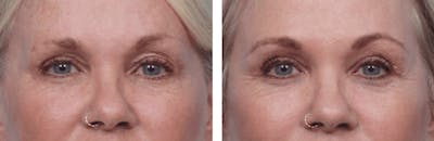 Dr. Balikian's Blepharoplasty Before & After Gallery - Patient 2167708 - Image 1