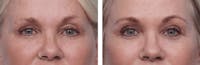 Dr. Balikian's Blepharoplasty Before & After Gallery - Patient 2167708 - Image 1