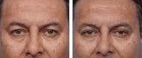 Dr. Balikian's Blepharoplasty Before & After Gallery - Patient 2167717 - Image 1