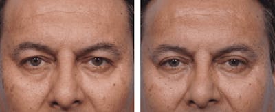 Dr. Balikian's Blepharoplasty Before & After Gallery - Patient 2167717 - Image 1