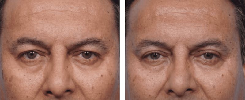 Dr. Balikian's Blepharoplasty Before & After Gallery - Patient 2167717 - Image 1