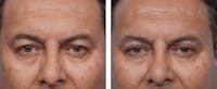 Dr. Balikian's Blepharoplasty Gallery - Patient 2167717 - Image 1