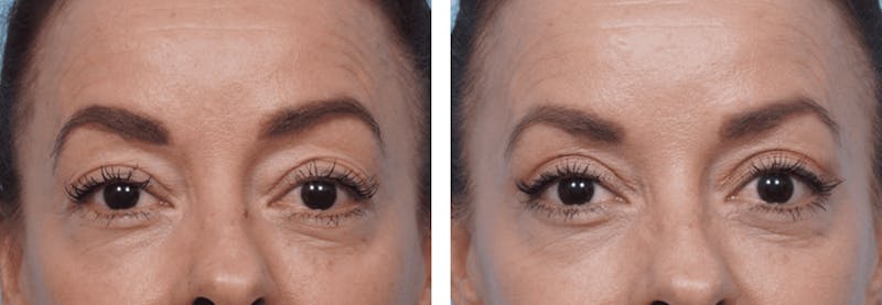 Dr. Balikian's Blepharoplasty Before & After Gallery - Patient 2167719 - Image 1