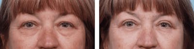Dr. Balikian's Blepharoplasty Before & After Gallery - Patient 2167721 - Image 1