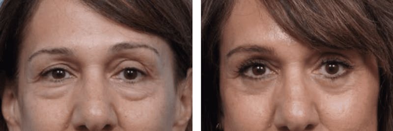 Dr. Balikian's Blepharoplasty Before & After Gallery - Patient 2167723 - Image 1