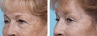 Dr. Balikian's Blepharoplasty Before & After Gallery - Patient 2167726 - Image 1