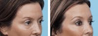 Dr. Balikian's Blepharoplasty Before & After Gallery - Patient 2167729 - Image 1