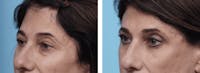 Dr. Balikian's Blepharoplasty Before & After Gallery - Patient 2167731 - Image 1