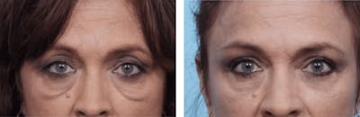 Dr. Balikian's Blepharoplasty Before & After Gallery - Patient 2167733 - Image 1