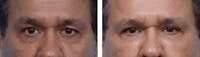 Dr. Balikian's Blepharoplasty Before & After Gallery - Patient 2167735 - Image 1