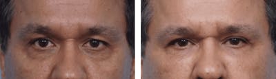 Dr. Balikian's Blepharoplasty Before & After Gallery - Patient 2167735 - Image 1