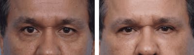 Dr. Balikian's Blepharoplasty Before & After Gallery - Patient 2167735 - Image 1