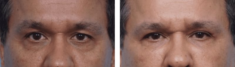 Dr. Balikian's Blepharoplasty Before & After Gallery - Patient 2167735 - Image 1