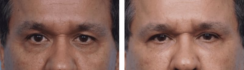 Dr. Balikian's Blepharoplasty Gallery - Patient 2167735 - Image 1
