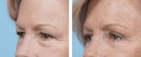 Dr. Balikian's Blepharoplasty Gallery - Patient 2167738 - Image 1
