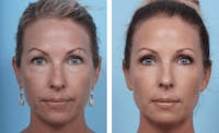 Dr. Balikian's Blepharoplasty Before & After Gallery - Patient 2167740 - Image 1
