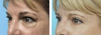 Dr. Balikian's Blepharoplasty Before & After Gallery - Patient 2167742 - Image 1