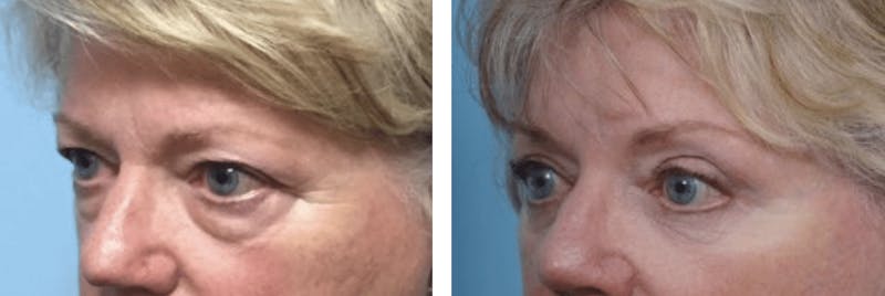 Dr. Balikian's Blepharoplasty Gallery - Patient 2167744 - Image 1