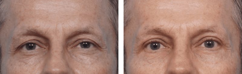 Dr. Balikian's Blepharoplasty Before & After Gallery - Patient 2167746 - Image 1