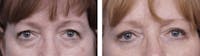 Dr. Balikian's Blepharoplasty Before & After Gallery - Patient 2167749 - Image 1