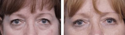 Dr. Balikian's Blepharoplasty Before & After Gallery - Patient 2167749 - Image 1