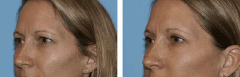Dr. Balikian's Blepharoplasty Before & After Gallery - Patient 2167755 - Image 1