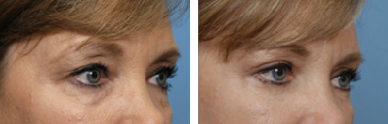 Dr. Balikian's Blepharoplasty Before & After Gallery - Patient 2167759 - Image 1