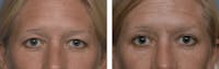Dr. Balikian's Blepharoplasty Before & After Gallery - Patient 2167761 - Image 1
