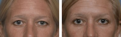 Dr. Balikian's Blepharoplasty Before & After Gallery - Patient 2167761 - Image 1