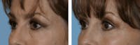 Dr. Balikian's Blepharoplasty Before & After Gallery - Patient 2167763 - Image 1