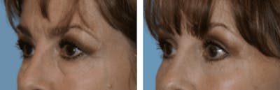 Dr. Balikian's Blepharoplasty Before & After Gallery - Patient 2167763 - Image 1