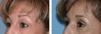 Dr. Balikian's Blepharoplasty Before & After Gallery - Patient 2167765 - Image 1