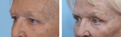 Dr. Balikian's Blepharoplasty Before & After Gallery - Patient 2167768 - Image 1