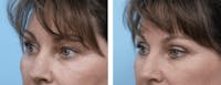 Dr. Balikian's Blepharoplasty Before & After Gallery - Patient 2167771 - Image 1