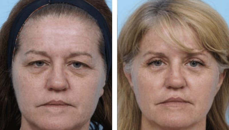 Dr. Balikian's Blepharoplasty Gallery - Patient 2167774 - Image 1