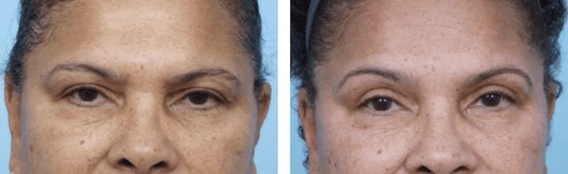 Dr. Balikian's Blepharoplasty Before & After Gallery - Patient 2167776 - Image 1