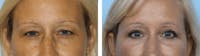 Dr. Balikian's Blepharoplasty Before & After Gallery - Patient 2167778 - Image 1