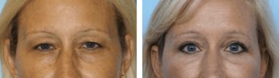 Dr. Balikian's Blepharoplasty Before & After Gallery - Patient 2167778 - Image 1