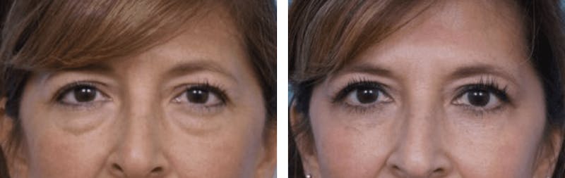 Dr. Balikian's Blepharoplasty Before & After Gallery - Patient 2167780 - Image 1