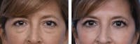 Dr. Balikian's Blepharoplasty Before & After Gallery - Patient 2167780 - Image 1