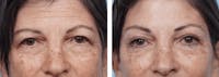 Dr. Balikian's Blepharoplasty Before & After Gallery - Patient 2167783 - Image 1